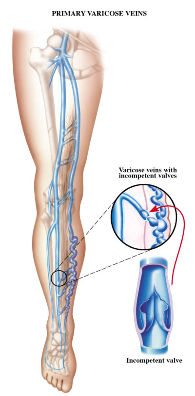 retours veineux varices